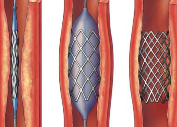 好消息！700元冠脈支架來了帶量采購結(jié)果在甘肅省正式落地執(zhí)行